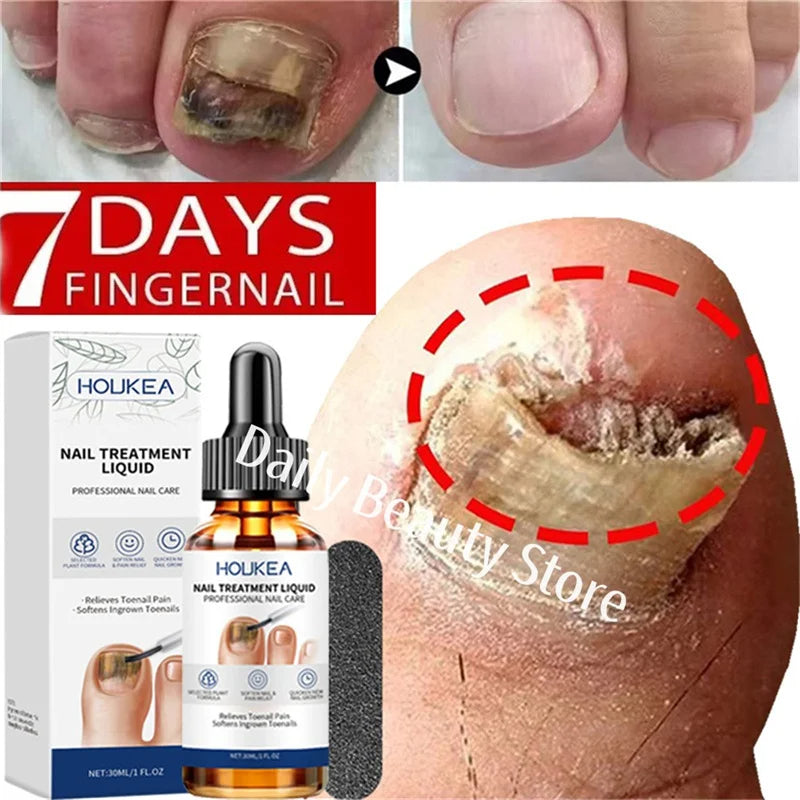 Nail Fungus Treatment Serum Foot Repair Liquid Toe Nails Fungal Removal Gel Anti Infection Paronychia Onychomycosis Cream 30ml