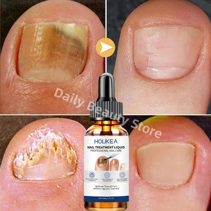 Nail Fungus Treatment Serum Foot Repair Liquid Toe Nails Fungal Removal Gel Anti Infection Paronychia Onychomycosis Cream 30ml